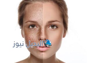 أفضل وصفة سحرية للتخلص من النمش