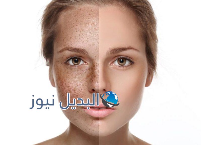 أفضل وصفة سحرية للتخلص من النمش