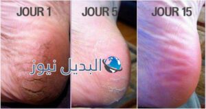 التخلص من تشققات القدمين