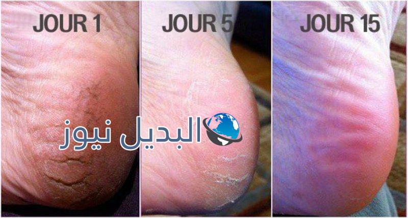 التخلص من تشققات القدمين
