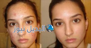 التخلص من حب الشباب وآثاره السيئة