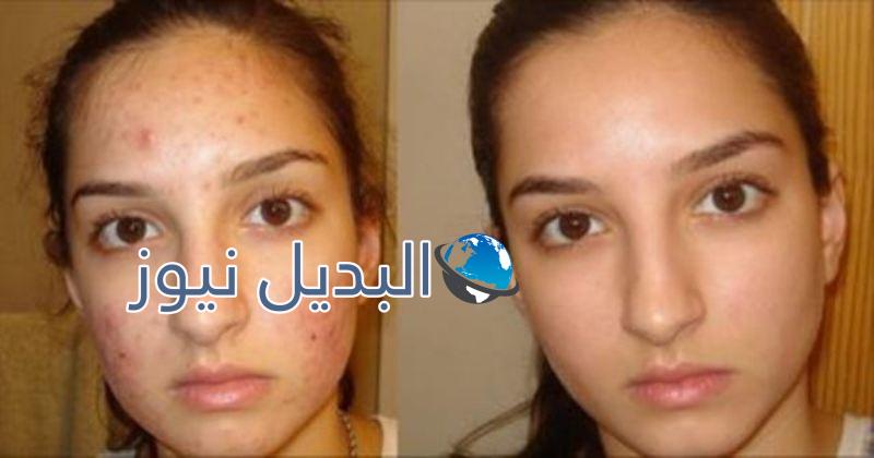 التخلص من حب الشباب وآثاره السيئة