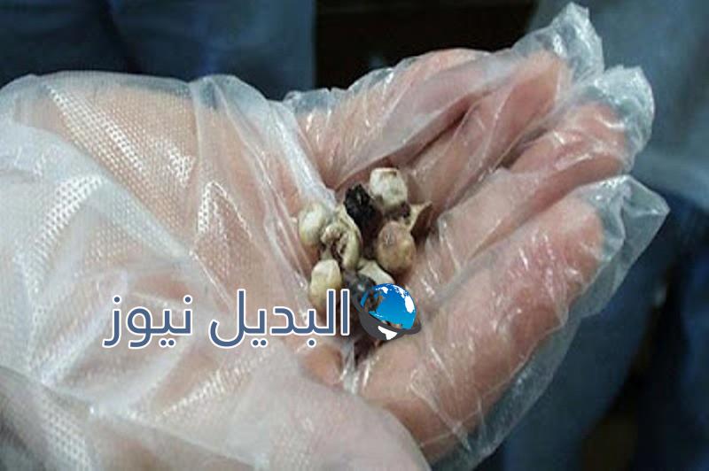 التخلص من حصى الكلى