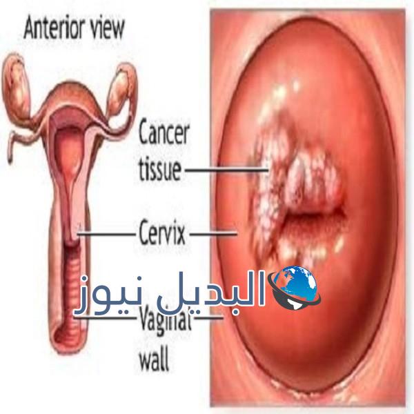 سرطان الرحم
