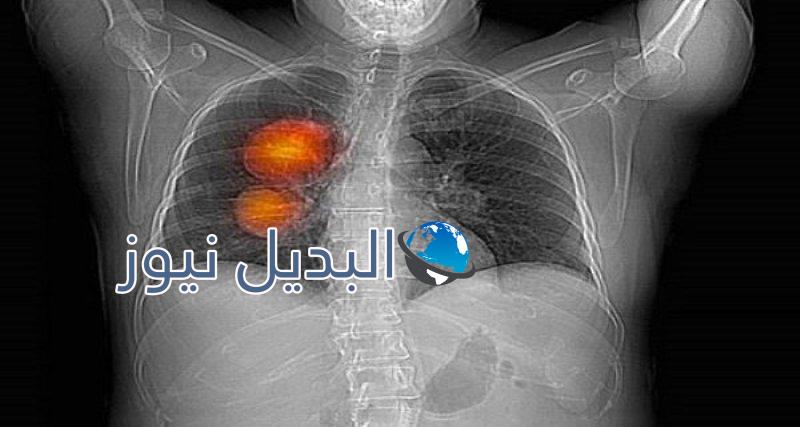 علامات الإصابة بالسرطان