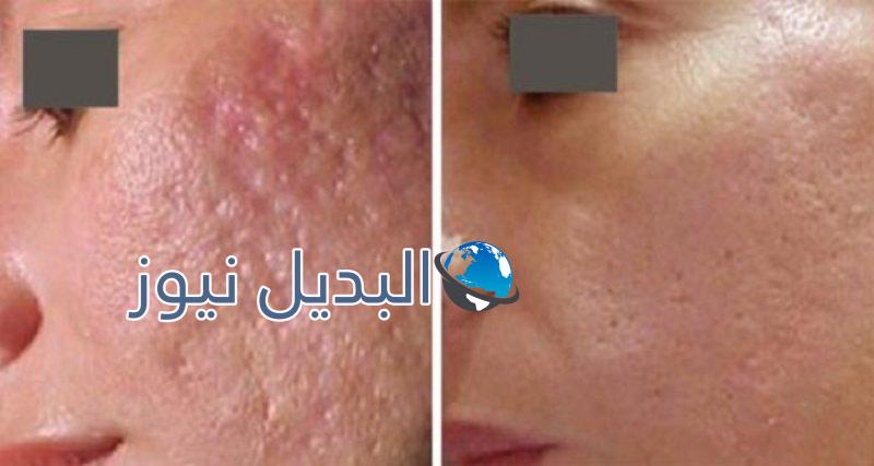 للتخلص من آثار وندبات حب الشباب