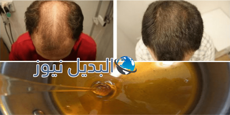 وصفة طبيعية لعلاج الصلع المبكر