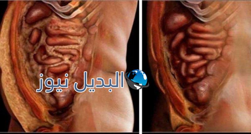 التخلص من رواسب الدهون والطفيليات