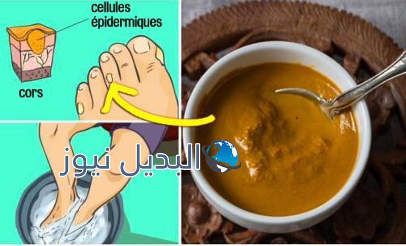 التخلص من مسمار القدم
