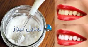الحصول على أسنان بيضاء كالثلج