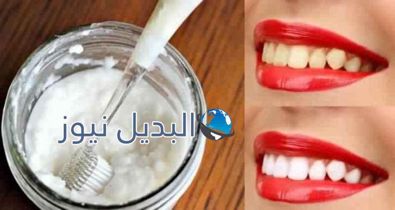 الحصول على أسنان بيضاء كالثلج