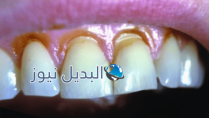 المحافظة على سلامة الأسنان