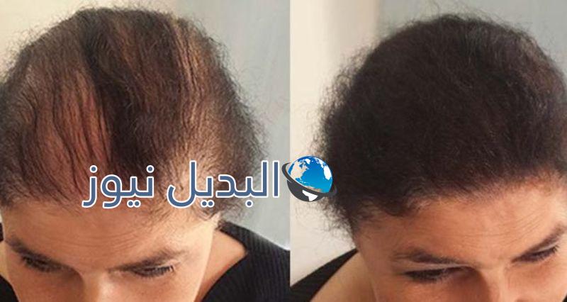 علاج الصلع وتطويل الشعر