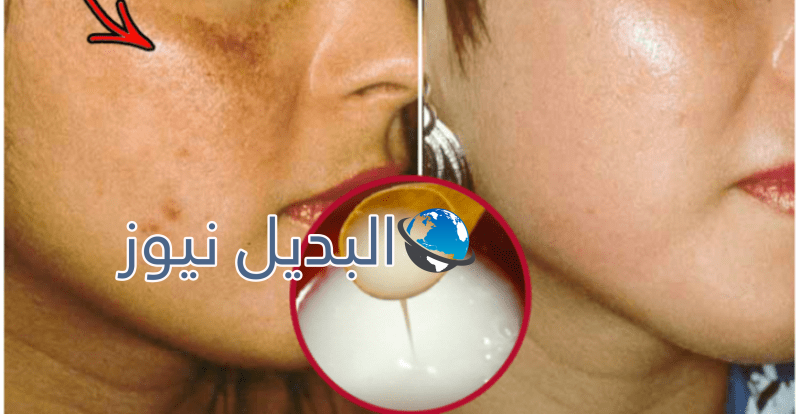 وصفة طبيعية للتخلص من الكلف