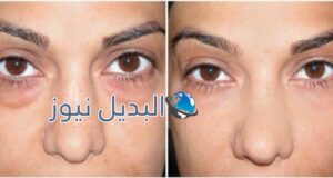التخلص من الهالات السوداء