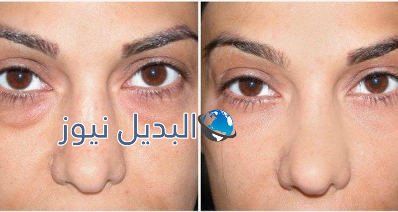 التخلص من الهالات السوداء