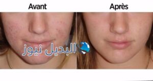 تنظيف الوجه بخل التفاح