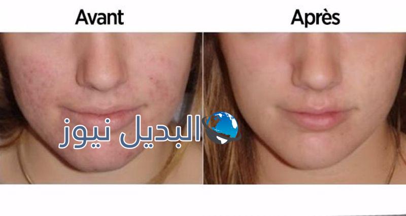 تنظيف الوجه بخل التفاح