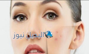 التخلص من حب الشباب