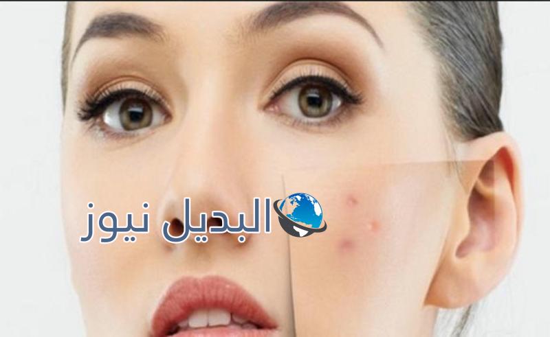 التخلص من حب الشباب