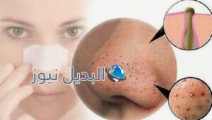 وصفة الملح والحامض للتخلص من الرؤوس السوداء