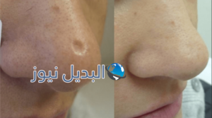 التخلص من نذوب الوجه وتبييض البشرة