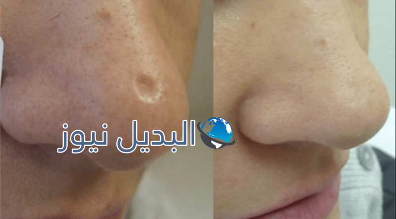 التخلص من نذوب الوجه وتبييض البشرة