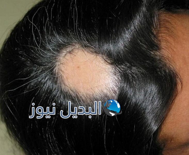 مرض الثعلبة