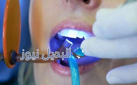 تبييض الأسنان بالليزر