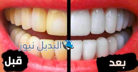 تبييض الأسنان بخلطات منزلية