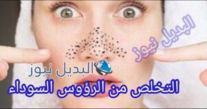 التخلص من الرؤوس السوداء