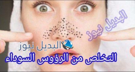 التخلص من الرؤوس السوداء