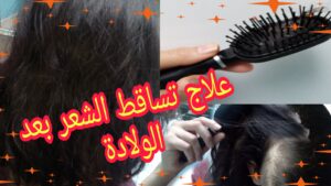 علاج تساقط الشعر بعد الولادة