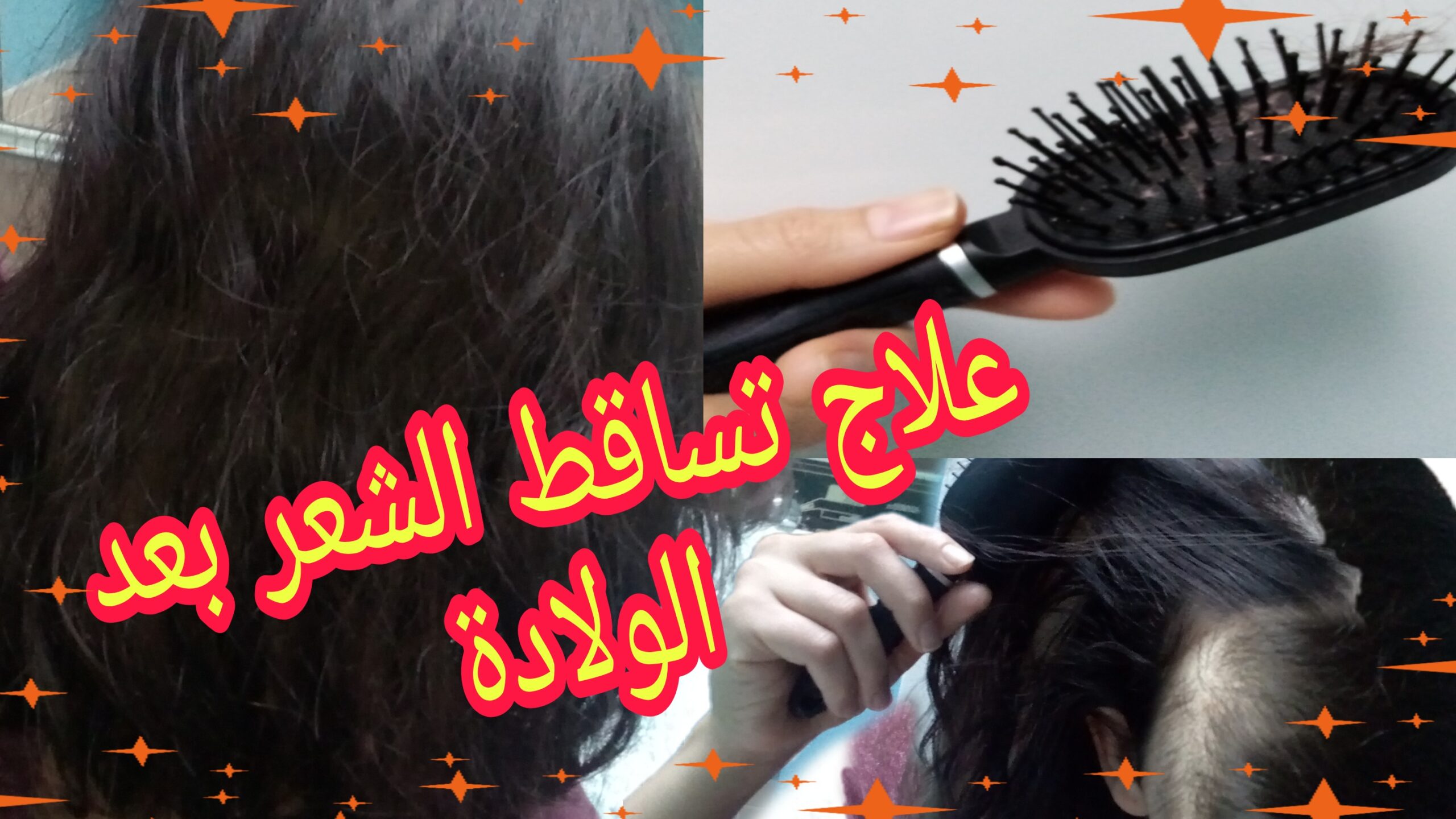 علاج تساقط الشعر بعد الولادة