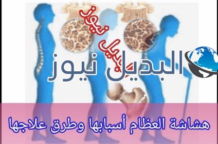 هشاشة العظام أسبابها وطرق الوقاية منها وعلاجها