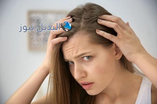 علاج القشر بالشعر