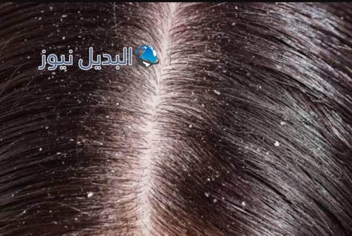 أسباب تكون قشرة الشعر