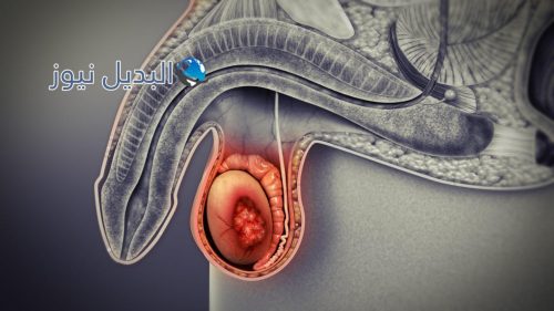 أعراض سرطان الخصية