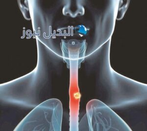 أعراض سرطان المريء