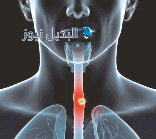 أعراض سرطان المريء