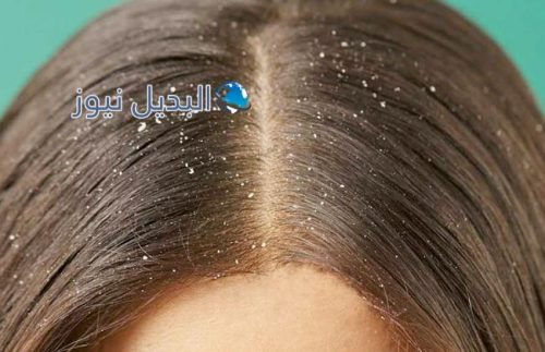 علاج قشرة الشعر بأفضل الحلول البسيطة