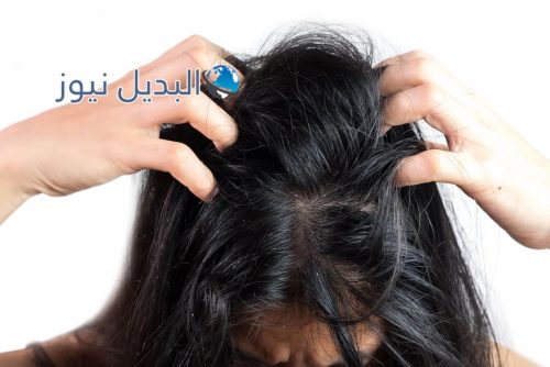 علاج قشرة الشعر بالثوم وصفات طبيعية
