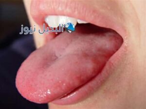 أعراض سرطان اللسان أسباب الإصابة وطرق العلاج