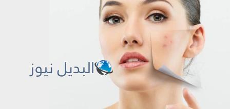 كيف يمكنني التخلص من حب الشباب