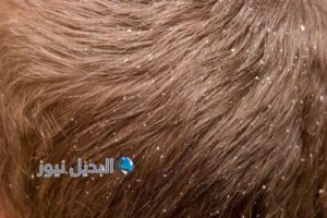 حلم القمل في شعري