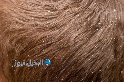 حلم القمل في شعري