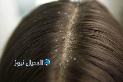 حلم القمل في الشعر