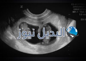 متى يظهر الحمل بتوأم