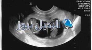 علامات الحمل بتوأم