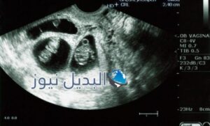 متى يظهر كيس الحمل بتوأم